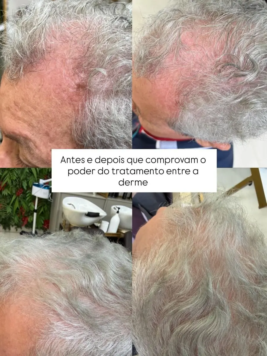Antes e depois de tratamento do couro cabeludo